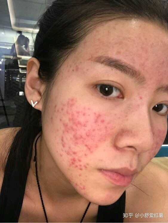 如何有效去除臉上的痘印——全方位指南，全方位指南，如何有效去除臉上痘印的方法