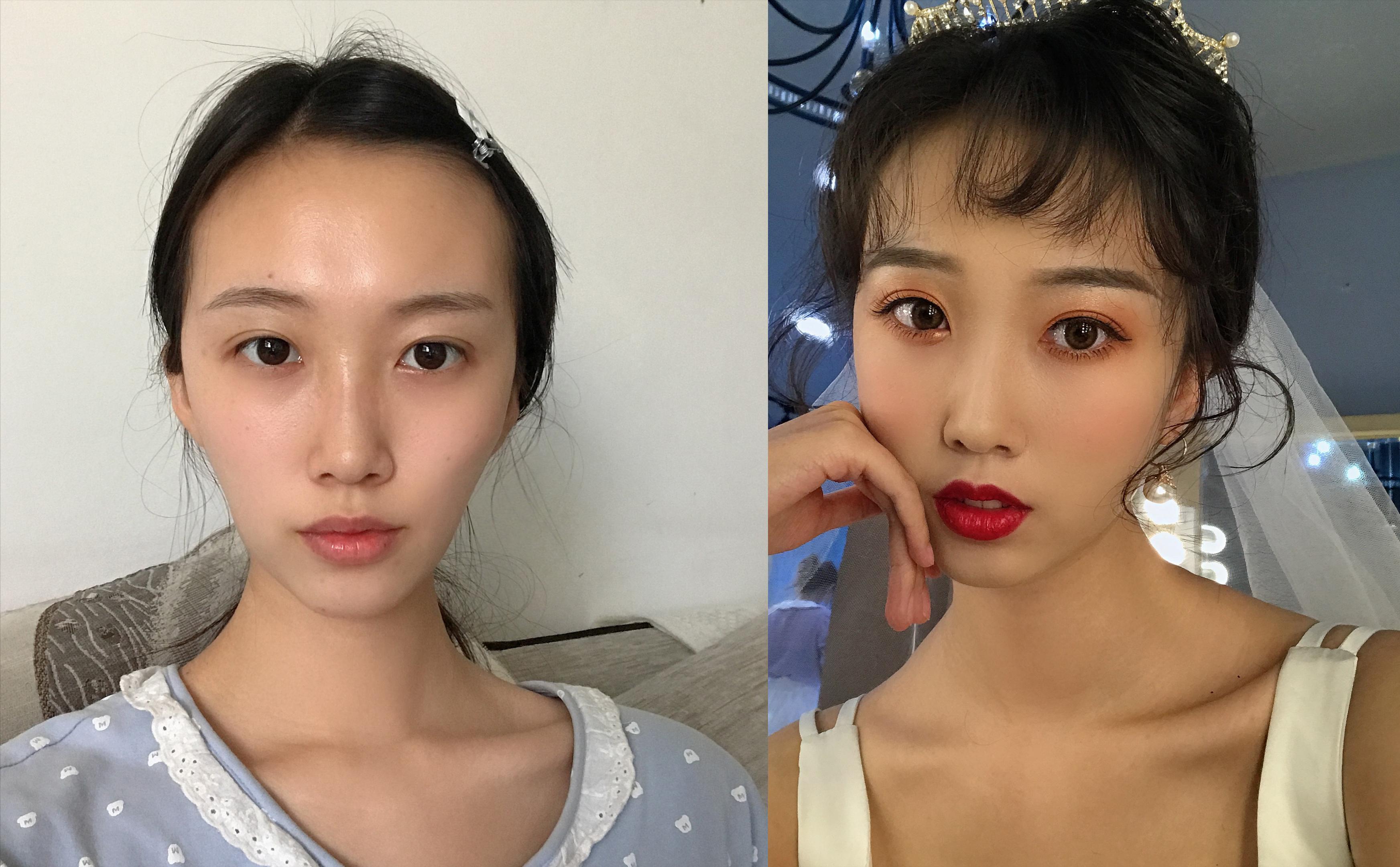自體填充脂肪，利弊分析，自體脂肪填充的利弊分析