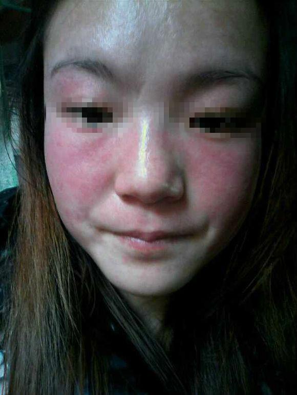 如何去掉黃褐斑的最好辦法，如何有效去除黃褐斑的方法探究
