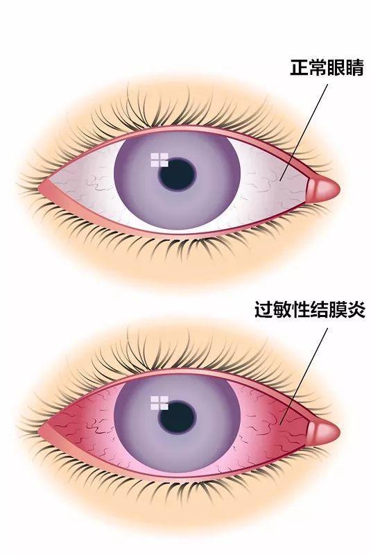 過敏性結膜炎，癥狀、原因及防治策略，過敏性結膜炎詳解，癥狀、成因與防治策略