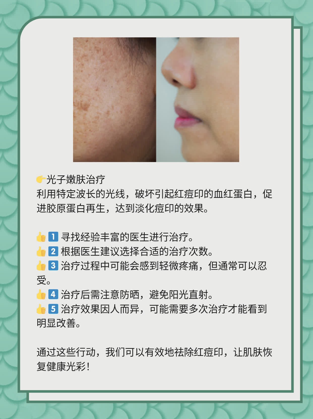 如何有效去除紅痘印，一站式解決方案，一站式解決紅痘印問題，有效去除方法大全