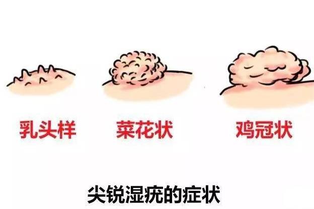尖銳濕疣與艾滋病，并非必然的前兆關(guān)聯(lián)，尖銳濕疣與艾滋病，非必然前兆關(guān)聯(lián)探討