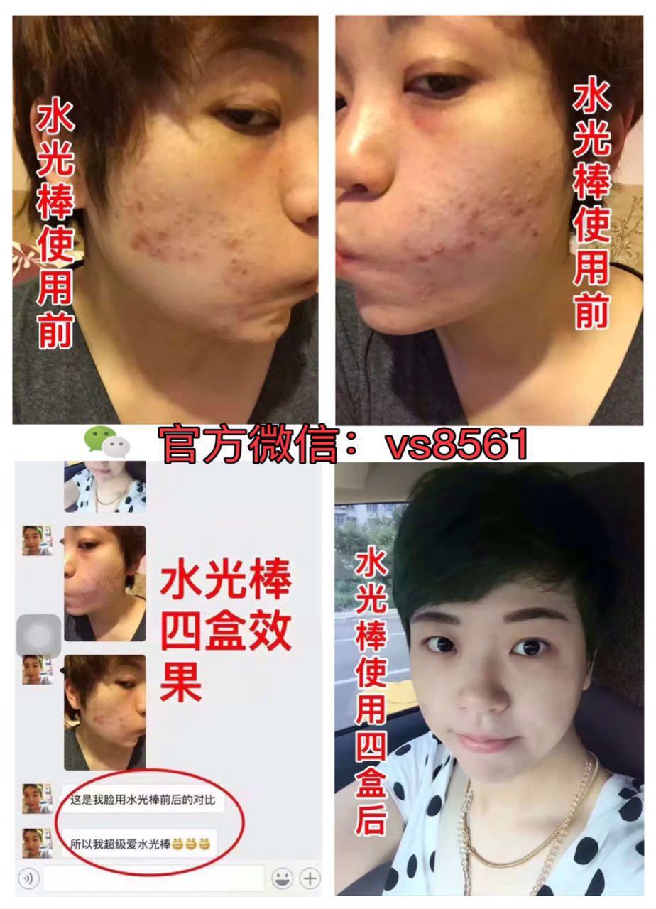 去除青春痘最有效的方法，全面解析最佳方案，全面解析，最有效的青春痘去除方案