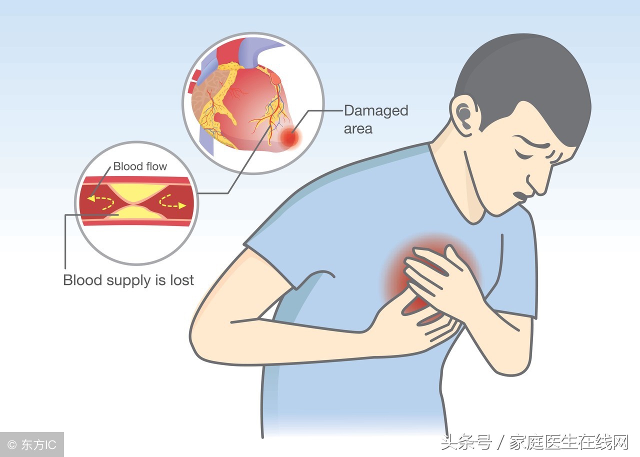 心肌梗塞的最佳治療方法，心肌梗塞的最佳治療方法解析