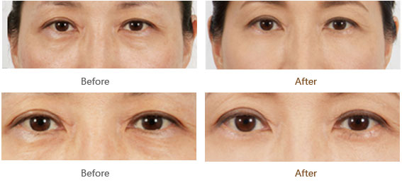 去眼袋手術(shù)全過(guò)程視頻解析，去眼袋手術(shù)全過(guò)程詳解視頻指南