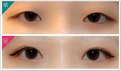 割雙眼皮多少錢呢？全面解析雙眼皮手術(shù)費(fèi)用因素，雙眼皮手術(shù)費(fèi)用全面解析，了解割雙眼皮的價格與影響因素