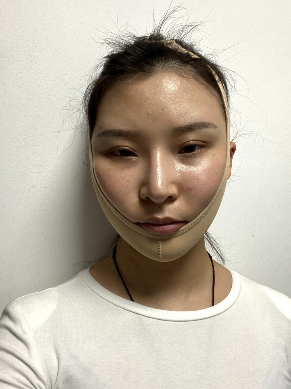 面部吸脂十天后的變化，圖片與經驗分享，面部吸脂十天，變化、圖片與經驗分享