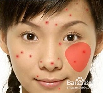 青春期長(zhǎng)痘痘了怎么消除，全面解析與應(yīng)對(duì)方法，青春期痘痘消除全面解析與應(yīng)對(duì)方法指南