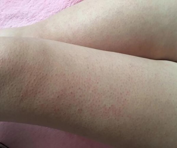 去除雞皮膚的小妙招，讓你的肌膚煥發(fā)自然光彩，雞皮膚改善秘訣，輕松告別不光滑，肌膚煥發(fā)自然光彩小妙招