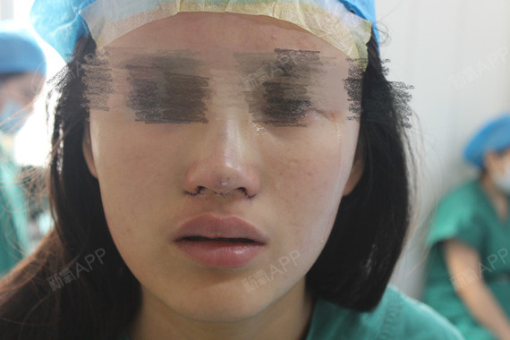 不動(dòng)手術(shù)縮小鼻頭，自然方法與實(shí)用技巧，自然縮小鼻頭的方法與實(shí)用技巧分享